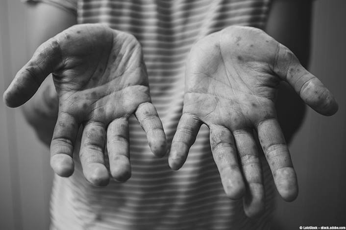 Zambales steps up drive vs. hand, foot and mouth&nbsp;disease